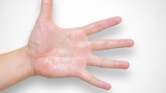 Какво предизвиква изпотяване на ръцете? 