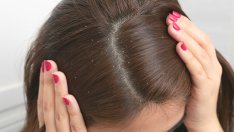 Как да използвате сода при пърхот и срещу косопад