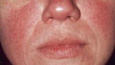 Топ 4 причини за почервеняване на лицето