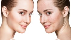 Еднодневна прочистваща диета срещу акне 