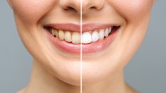 Как да избелим зъбите си у дома?