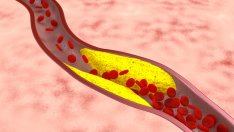 Симптоми, подсказващи за артериални проблеми