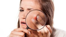 Бързо и лесно премахване на черните точки