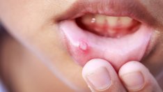 Причини, симптоми и лечение на язви и афти в устата