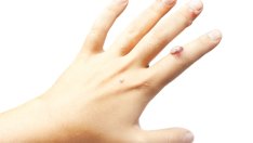 Всичко, което трябва да се знае за HPV