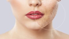 Храни, борещи се с акнето и черните точки