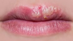 Природни лекове при херпес