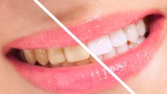 Храни и напитки, от които зъбите пожълтяват 