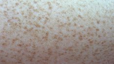 Как да преглеждаме кожата за съмнителни пигментни петна?