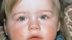 Опасна ли е заушката?