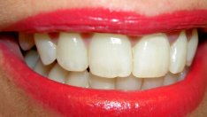 Витамин E помага при пародонтоза