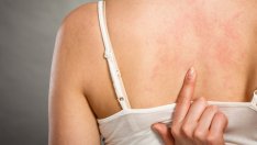 Коварни симптоми на лупус, за които не подозирате 