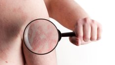 5 кожни заболявания, подсказващи за други здравословни проблеми