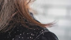 Витамини и минерали, които могат да помогнат при пърхот 