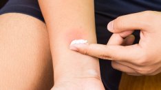 Състояния, които често се бъркат с алергия 