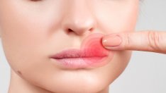 Натурални лекове при херпес