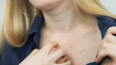 Какво предизвиква акне по деколтето? 