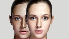 Витамини при хиперпигментация на кожата