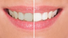 Неочаквани причини зъбите ви да се оцветят