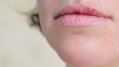 Как да се предпазите от херпес?