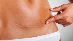 Как да заличим неприятните белези