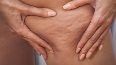 Сбогом, целулит! 6 начина да се преборите с него