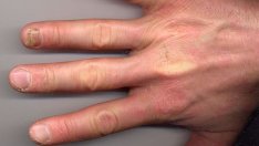 Ноктите могат да подсказват за наличие на заболяване