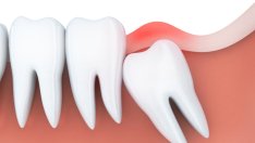 Защо пушенето след изваждане на мъдрец е опасно 