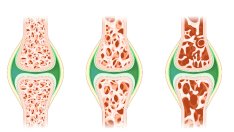 На всеки час в България се регистрират по шест фрактури заради остеопороза