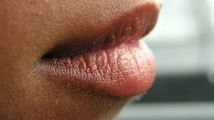 Сухите и напукани устни подсказват за редица здравословни проблеми