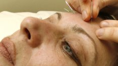 Акупунктурата облекчава симптомите на  менопауза