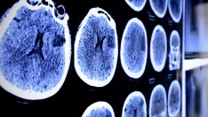 Рискови фактори за инсулт при жените