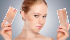 Чао, чао, акне!