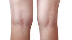 Природни средства за облекчаване на разширени вени