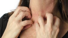 Да преборим кожните алергии натурално