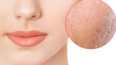 Акне, причинено от стрес – как да го разпознаете? 