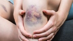 8 причини за необясними синини по тялото 