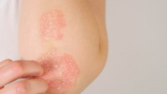 Кожен симптом, който може да подсказва за непоносимост към глутен