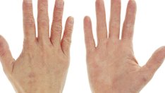 Симптоми и лечение на екземата