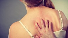 Натурални лекове при акне по гърба и деколтето 