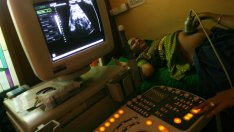 Важни факти за рака на яйчниците, които е добре да знаем