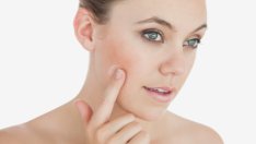 Естествено премахване на белези от акне