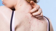 Какво причинява акне по гърба? 