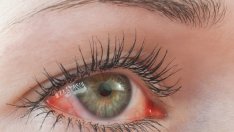 Домашни средства при зачервени очи