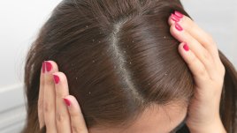 Как да използвате сода при пърхот и срещу косопад