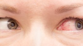 Най-честите причини за зачервени очи