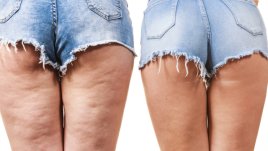 5 билки за елиминиране на целулита