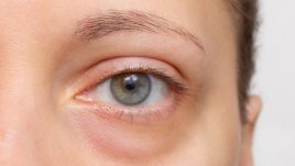 Най-ефикасните масла против торбички под очите