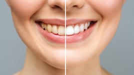 Как да избелим зъбите си у дома?