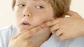 Акне – бич за тийнейджъри и не само